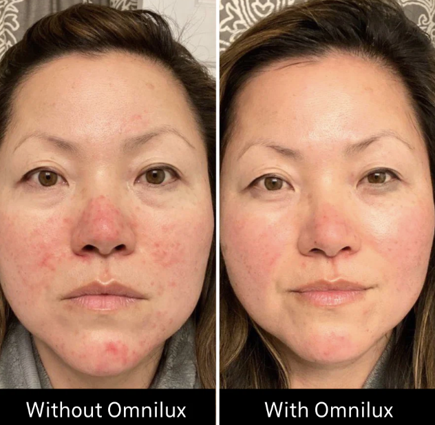 Omnilux LED Contour Face Mask