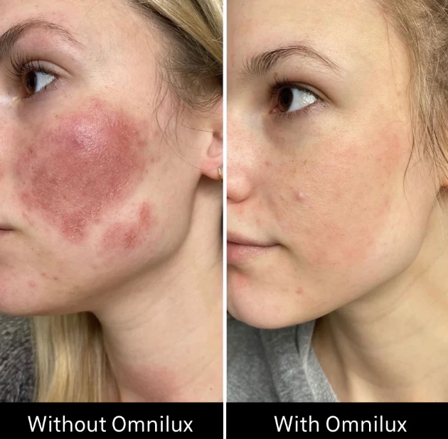 Omnilux LED Contour Face Mask