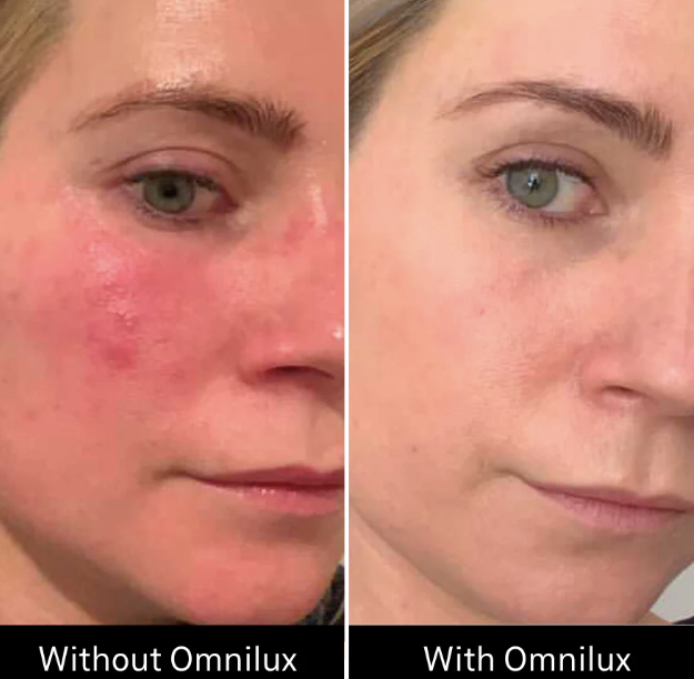 Omnilux LED Contour Face Mask